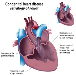 Congenital heart defects