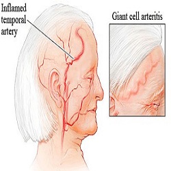 Giant Cell Arteritis