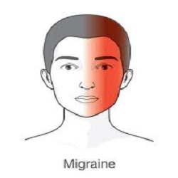 Migraine Headaches