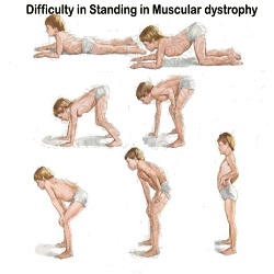 Muscular Dystrophy