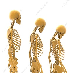 Osteoporosis