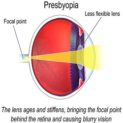 Presbyopia